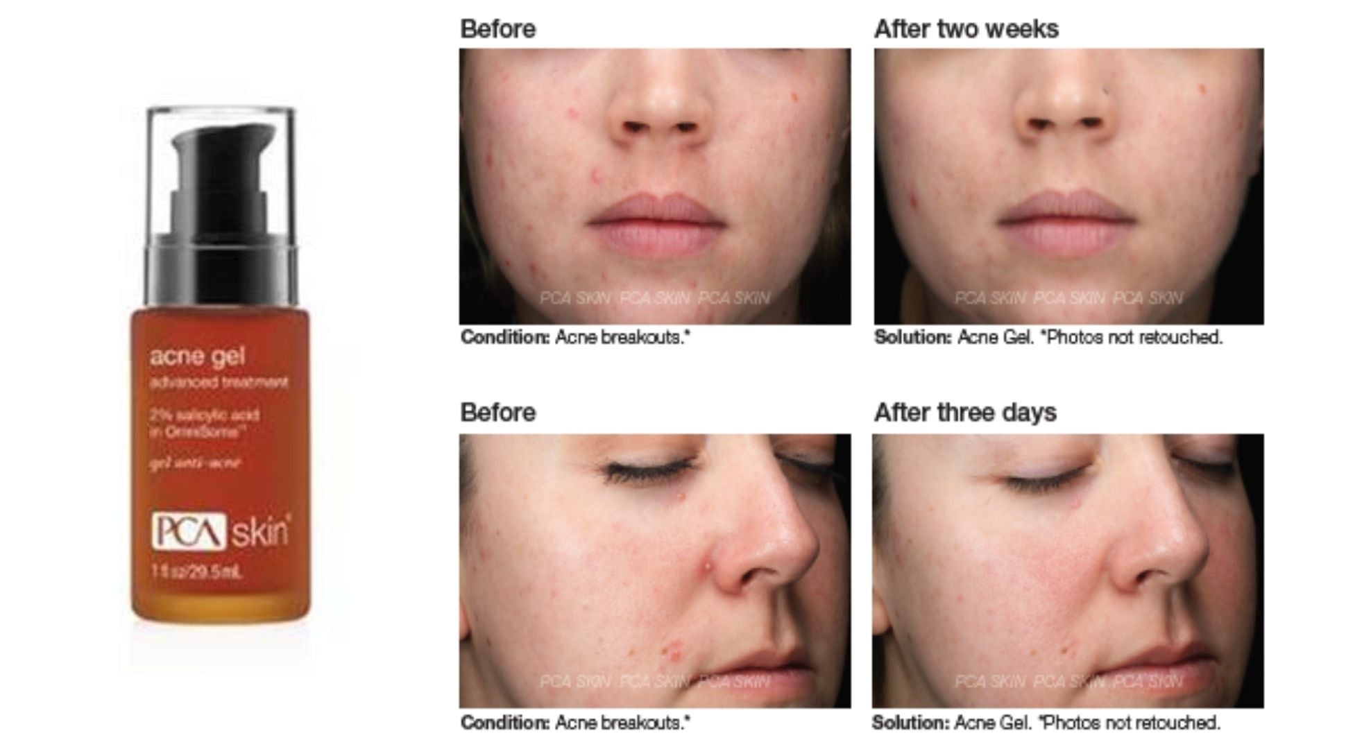 review, ingredients, skin care, photos, trends, 2020, 2021, pca skin, acne gel, salicylic acid, acne treatment, how to get clear skin, high end skincare products, pimples, blackheads, whiteheads